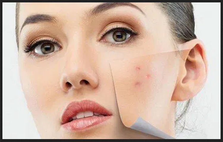 Sivilce İzlerini Yok Eden Maske Tarifleri