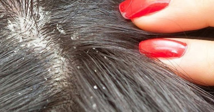 Kepekli Ve Dökülen Saçlar İçin Maske